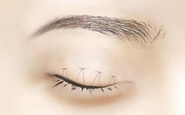 2023年武漢專業(yè)祛川字紋醫(yī)院排行榜出爐，TOP10強(qiáng)名單公布！