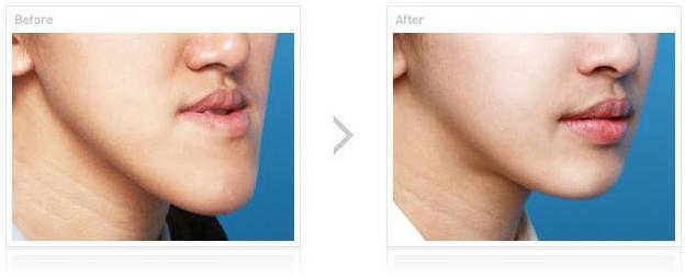 2023年成都環(huán)形吸脂手術(shù)醫(yī)院排行榜TOP10，選擇靠譜的整形醫(yī)院才能擁有理想效果！