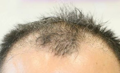 南寧有哪些給人注射木偶紋的醫(yī)療美容醫(yī)院效果好？2023年南寧木偶紋注射整形醫(yī)院排行榜前10強(qiáng)評選揭曉！