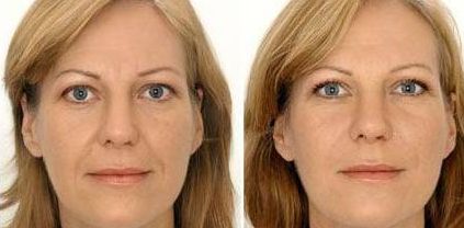 北京最新小腹激光溶脂口碑排行TOP5醫(yī)院揭秘！