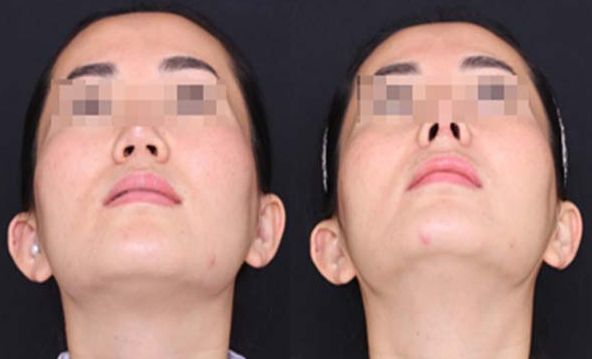 合肥自己的脂肪填充下巴整形醫(yī)院排名前三、前五+費(fèi)用全新一覽!