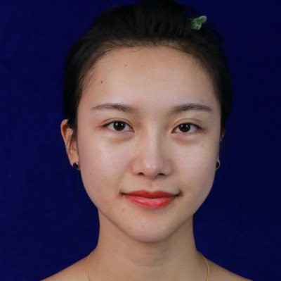 眼綜合術(shù)前VS術(shù)后，自然大眼睛值得稱贊！