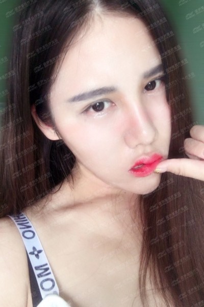 呼和浩特諾伊美劉星赫醫(yī)師鼻部多項手術(shù)案例反饋