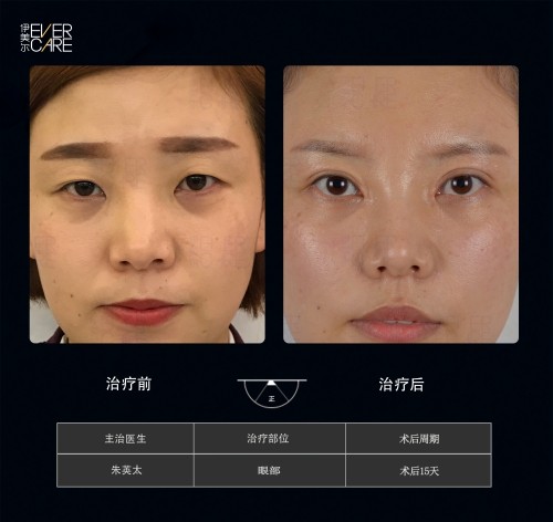 阿爾法9°美眼，打開視界，美無止境