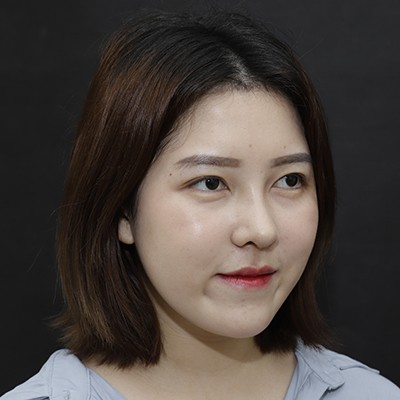 廣州美恩半肋鼻手術(shù)恢復(fù)效果反饋，主任親自操刀的效果就是贊！