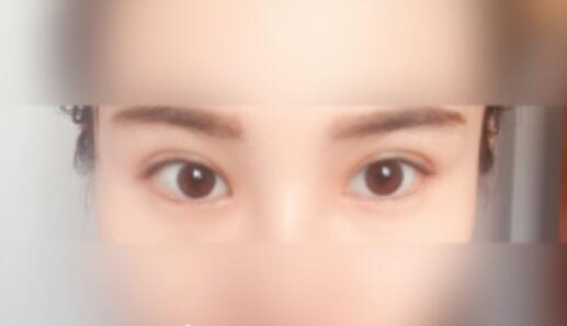 延吉金光善整形雙眼皮一個(gè)月效果分享，有對(duì)比圖