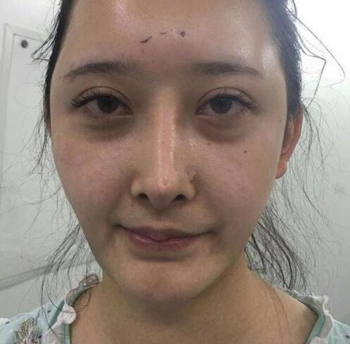 深圳陽光全臉填充術(shù)前術(shù)后對比，說年輕十歲不過分吧