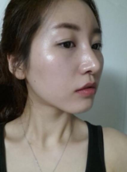 武漢中翰整形駝峰鼻矯正案例術(shù)后兩個(gè)月效果 武漢中翰整形駝峰鼻矯正案例術(shù)后兩個(gè)月效果