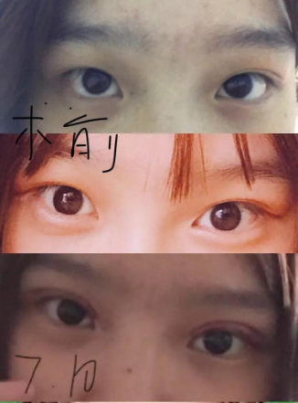 做雙眼皮案例，濟南坤如瑪麗崔金珍雙眼皮案例圖片