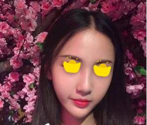 深圳鵬愛做隆鼻手術一個月效果 深圳鵬愛做隆鼻手術一個月效果