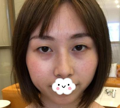 武漢亞太整形雙眼皮術(shù)后一個(gè)月效果分享