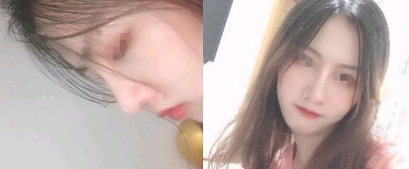 濱州醫(yī)學院附屬醫(yī)院做隆鼻三個月效果 濱州醫(yī)學院附屬醫(yī)院做隆鼻三個月效果