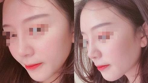 耳軟骨隆鼻術(shù)后三個(gè)月，我有了韓佳人同款美鼻