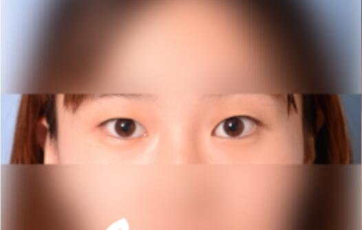 延吉金光善整形雙眼皮一個(gè)月效果分享，有對(duì)比圖