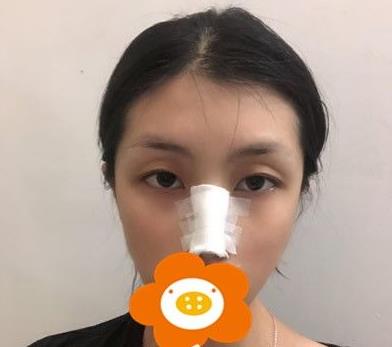 溫州韓美周杰群醫(yī)生耳軟骨隆鼻案例分享術(shù)后即刻 溫州韓美周杰群醫(yī)生耳軟骨隆鼻案例分享術(shù)后即刻