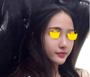 塌鼻子小妹在深圳鵬愛(ài)做隆鼻手術(shù)，三個(gè)月后竟然是這樣的