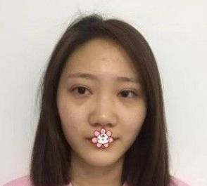 北京彤美耳軟骨隆鼻案例分享術前效果 北京彤美耳軟骨隆鼻案例分享術前效果