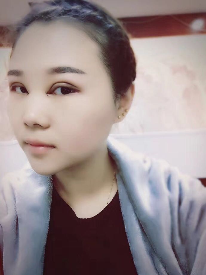 汕頭曙光雙眼皮一周側(cè)面效果 汕頭曙光雙眼皮一周側(cè)面效果