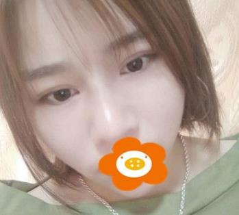 據(jù)說杭州薇琳隆鼻后效果很自然，有案例嗎