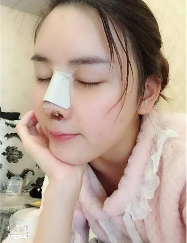 北京哪家隆鼻好？花一萬鼻子做成這樣值不值