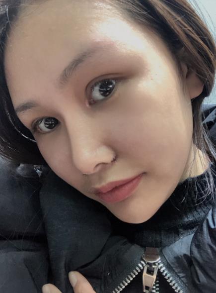 長(zhǎng)春中研整形黃帝云鼻頭縮小案例術(shù)后一個(gè)月效果