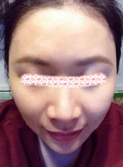 西安米蘭柏羽整形手術(shù)縮鼻翼案例分享術(shù)后兩個(gè)月效果 西安米蘭柏羽整形手術(shù)縮鼻翼案例分享術(shù)后兩個(gè)月效果