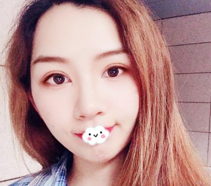 武漢伊萊美割雙眼皮案例分享術后一個月效果 武漢伊萊美割雙眼皮案例分享術后一個月效果