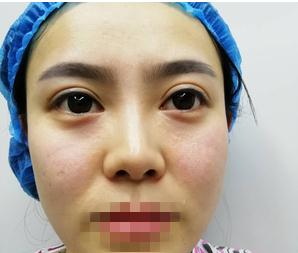 親身經(jīng)驗，重慶星范整形的超體隆鼻真的很自然