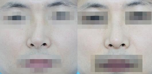 天津時(shí)光整形歪鼻矯正案例前后對(duì)比圖 天津時(shí)光整形歪鼻矯正案例前后對(duì)比圖