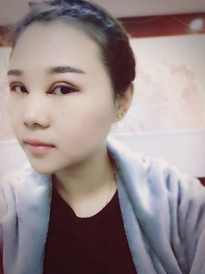 腫眼泡應(yīng)該做哪種雙眼皮？汕頭曙光雙眼皮三個月效果分享