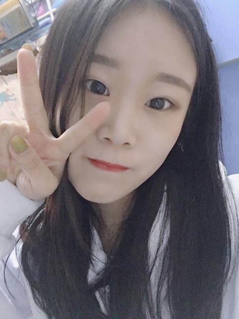 石家莊諾萬整形肋軟骨隆鼻案例術(shù)后一個(gè)月效果 石家莊諾萬整形肋軟骨隆鼻案例術(shù)后一個(gè)月效果