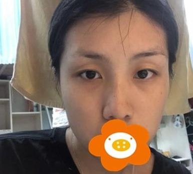 救命，周杰群做的耳軟骨隆鼻恢復后鼻背線條也太好看了吧