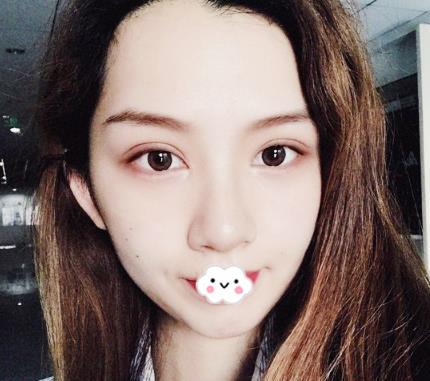 武漢伊萊美割雙眼皮案例分享術后半個月效果 武漢伊萊美割雙眼皮案例分享術后半個月效果