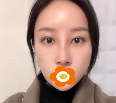 萬萬沒想到在鄭州禾麗做的肋軟骨隆鼻效果居然是這樣的