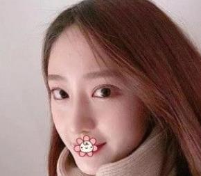 北京彤美耳軟骨隆鼻案例分享術后一個月效果 北京彤美耳軟骨隆鼻案例分享術后一個月效果