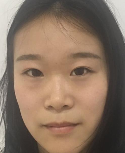 石家莊諾萬整形肋軟骨隆鼻案例術(shù)前效果 石家莊諾萬整形肋軟骨隆鼻案例術(shù)前效果