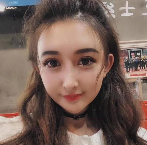 深圳陽光全臉填充術(shù)前術(shù)后對比，說年輕十歲不過分吧