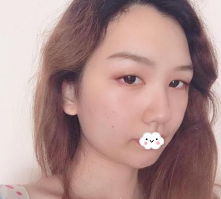 武漢伊萊美割雙眼皮怎么樣？切開(kāi)雙眼皮恢復(fù)過(guò)程圖