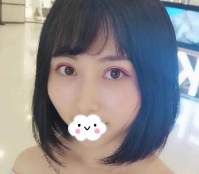 武漢亞太整形雙眼皮術(shù)后一個(gè)月效果分享