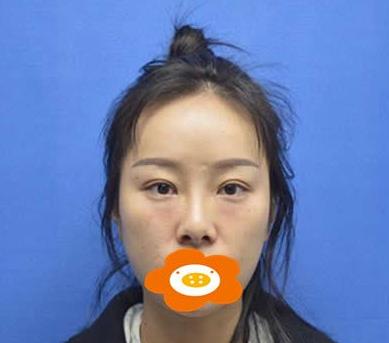 鄭州禾麗做肋軟骨隆鼻術(shù)前效果