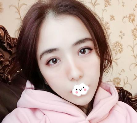 大連沙醫(yī)生整形付德林做的自體軟骨隆鼻效果，給大家做個參考