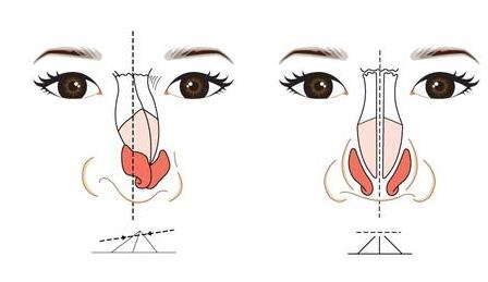 天津時(shí)光整形歪鼻矯正 天津時(shí)光整形歪鼻矯正