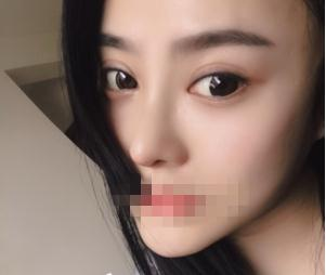 親身經(jīng)驗，重慶星范整形的超體隆鼻真的很自然