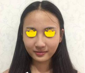 塌鼻子小妹在深圳鵬愛(ài)做隆鼻手術(shù)，三個(gè)月后竟然是這樣的