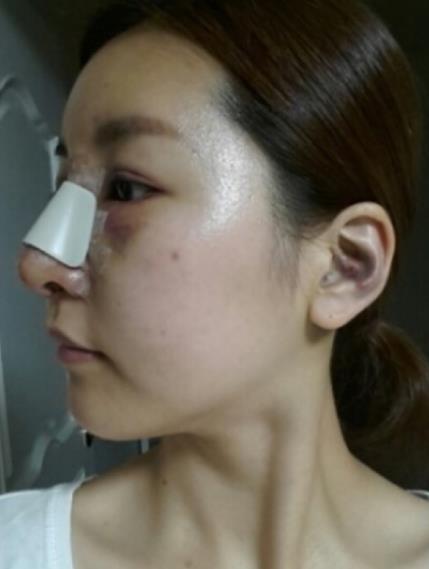 武漢中翰整形駝峰鼻矯正案例術(shù)后第二天效果 武漢中翰整形駝峰鼻矯正案例術(shù)后第二天效果