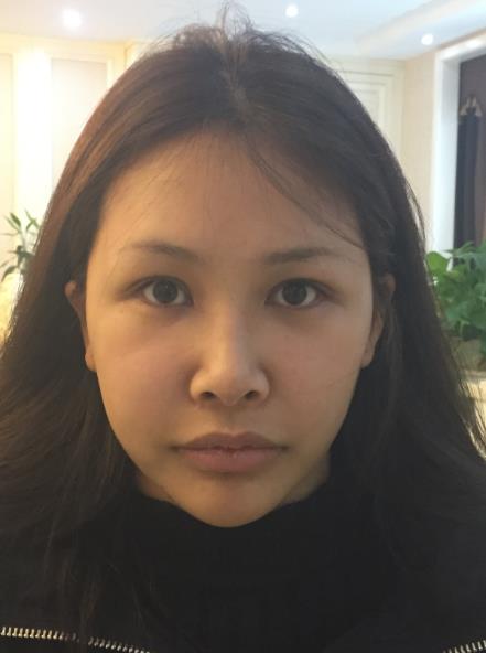 長(zhǎng)春中研整形黃帝云鼻頭縮小案例術(shù)前效果