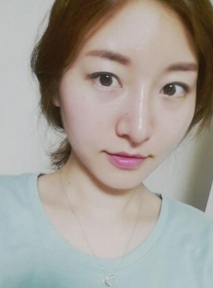 武漢中翰整形駝峰鼻矯正案例術(shù)后三個(gè)月效果 武漢中翰整形駝峰鼻矯正案例術(shù)后三個(gè)月效果