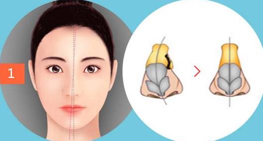 做歪鼻矯正前后效果 做歪鼻矯正前后效果