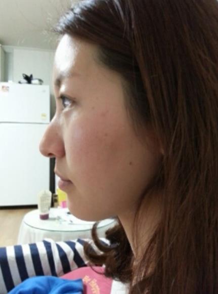 武漢中翰整形駝峰鼻矯正案例術(shù)前效果 武漢中翰整形駝峰鼻矯正案例術(shù)前效果