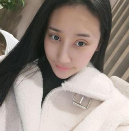 昆明麗都整形雙眼皮修復案例術(shù)后一個月 昆明麗都整形雙眼皮修復案例術(shù)后一個月